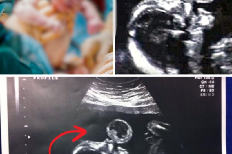 Mom Sees Baby ‘Blowing Bubble’ On Ultrasound, Doctor Tells Her To Abort