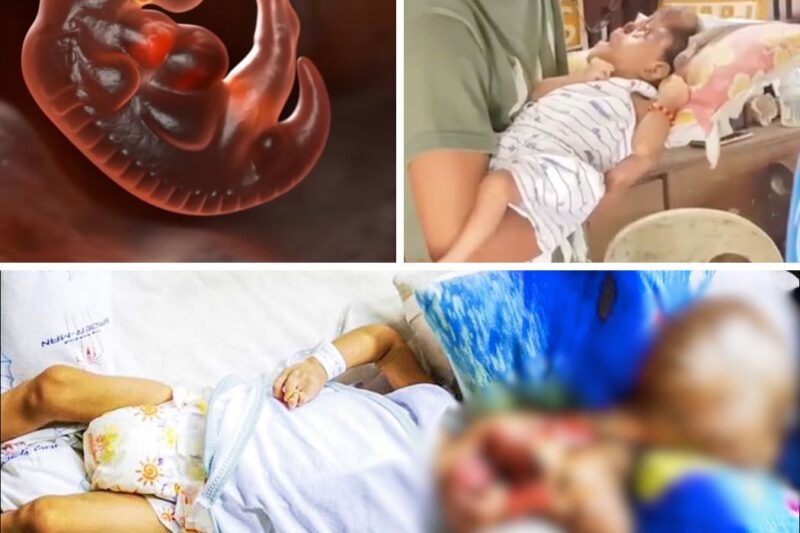 Baby Born Without a Face Survives and Did the Unthinkable